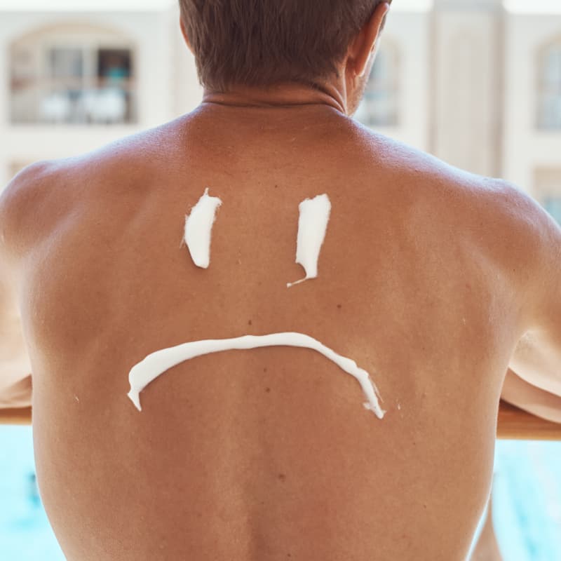 Sad Smile on mans back | How to sleep with sunburn | e-Surgery